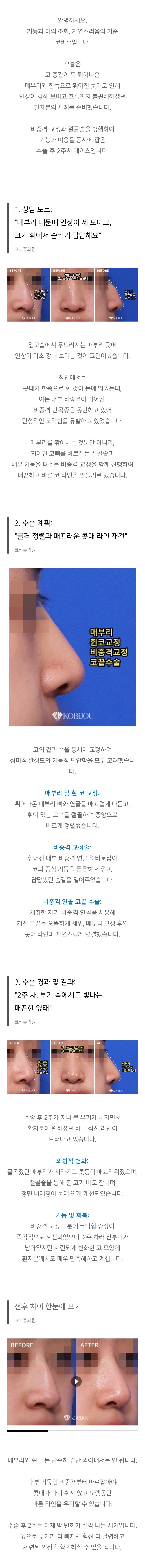 강남 코 성형외과
